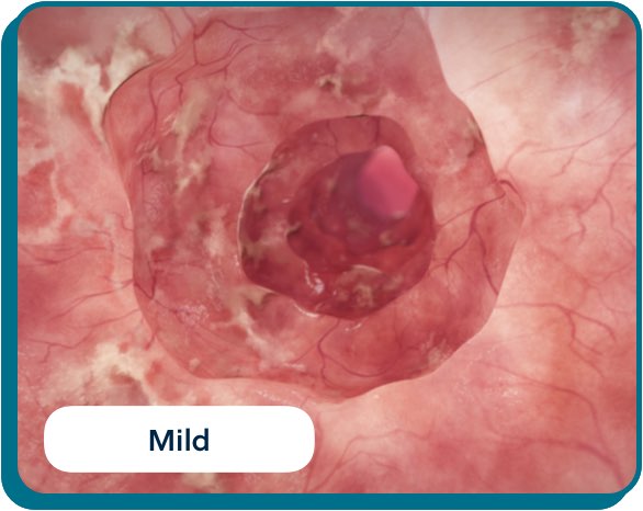 UC Inflammation bio images