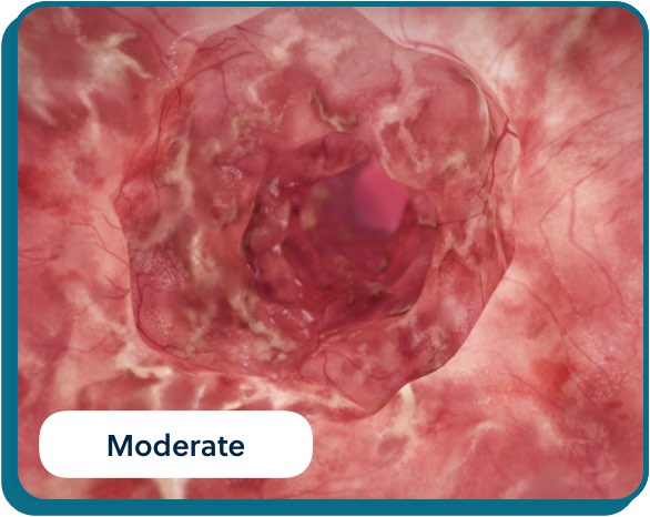 UC Inflammation bio images