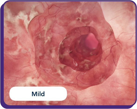 mild UC inflammation