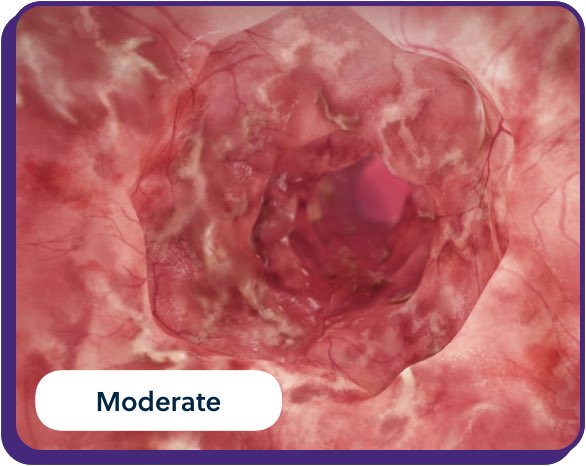 moderate UC inflammation