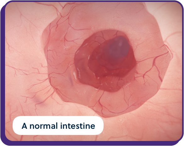 a normal intestine