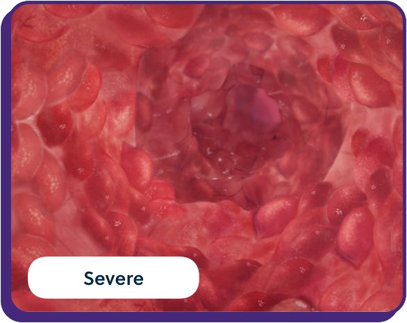 severe UC inflammation