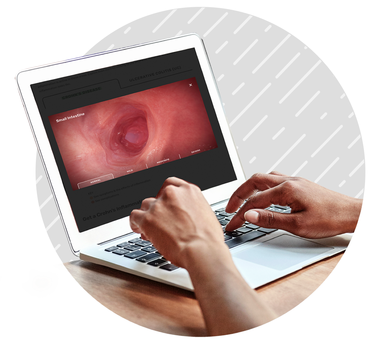 Person sitting at a desk viewing inflammation inside the body on a laptop