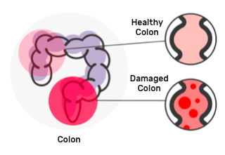 Healthy colon vs damaged colon