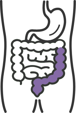 Left-sided colitis diagram